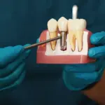 What are the Factors Affecting Dental Implant Longevity?