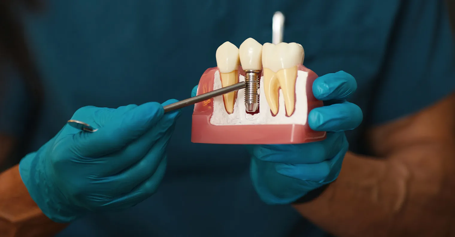 What are the Factors Affecting Dental Implant Longevity?