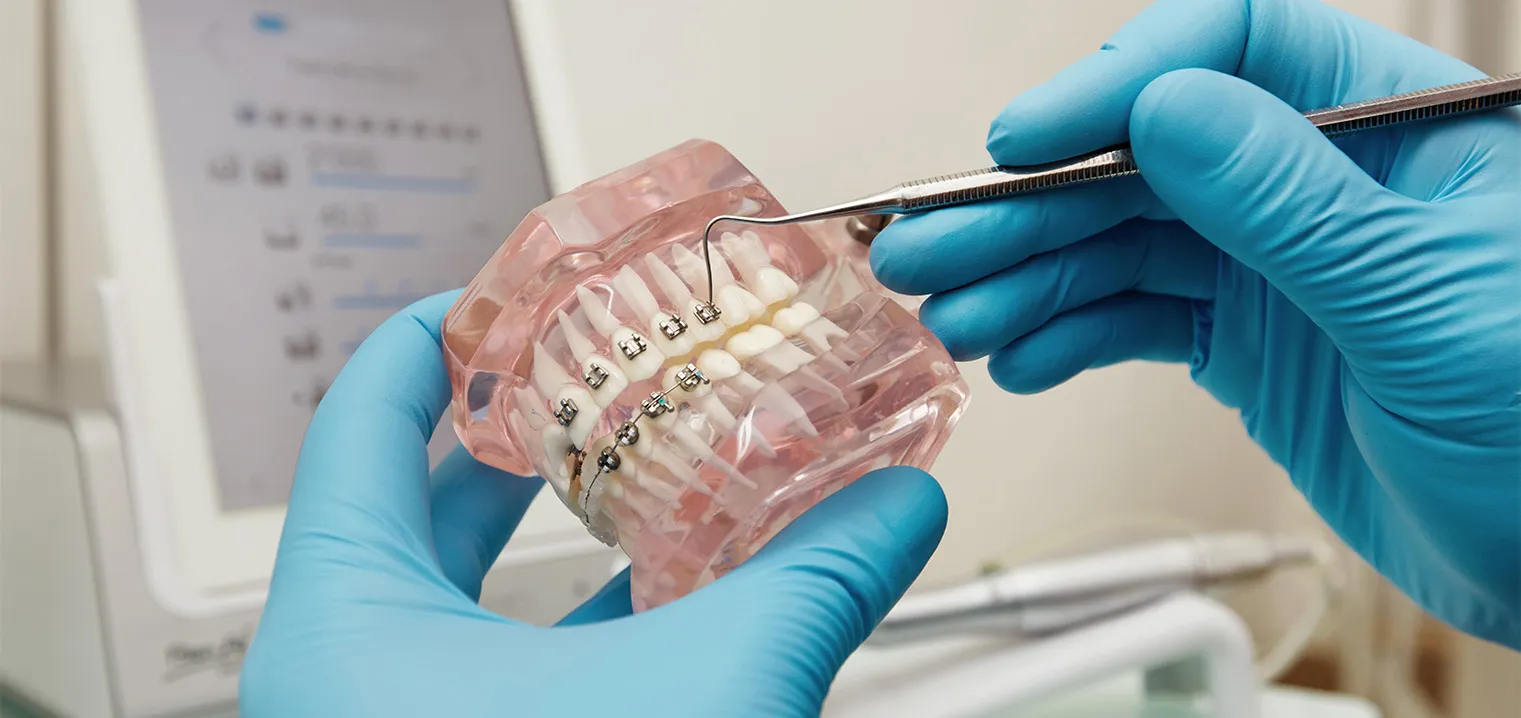 Metal vs. Ceramic vs. Damon Braces: Which Option Suits the Dubai Lifestyle?